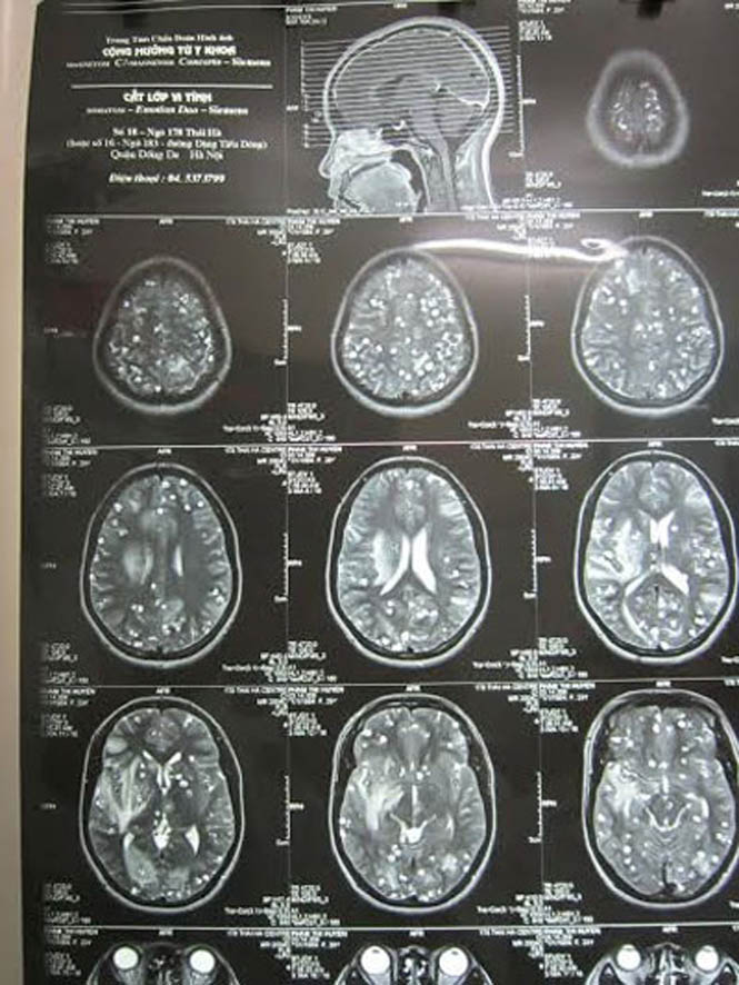 Những nốt tròn trong có nhân là nang sán lợn làm tổ dày đặc trong não bệnh nhân (Ảnh: Zing.vn)