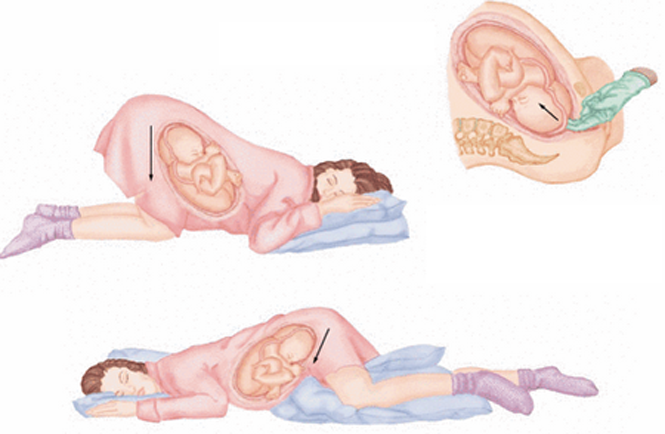  Hướng dẫn thai phụ nằm đầu thấp, mông cao khi bị sa dây rốn.