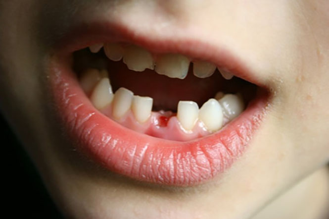  Bộ răng sữa có vai trò quan trọng nên các bậc phụ huynh cần quan tâm đến việc chăm sóc và giữ gìn răng (ảnh:KT)