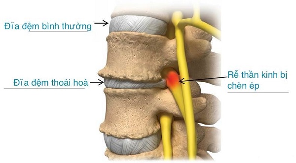 Đĩa đệm thoái hóa gây đau thắt lưng cho người bệnh.