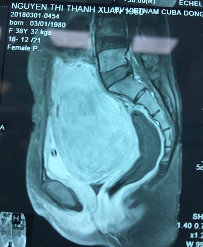 Hình ảnh khối u trên phim chụp CT scanner