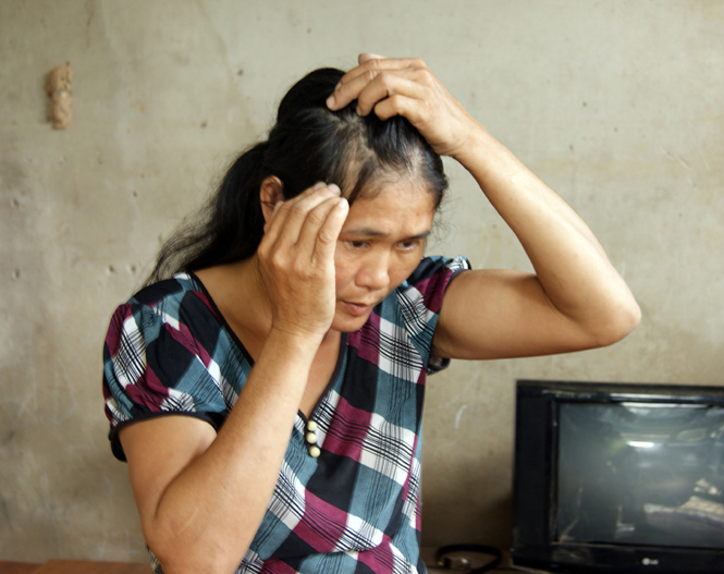 Bà Vinh cho biết, hiện vết thương trên đầu đang còn đau nhức.