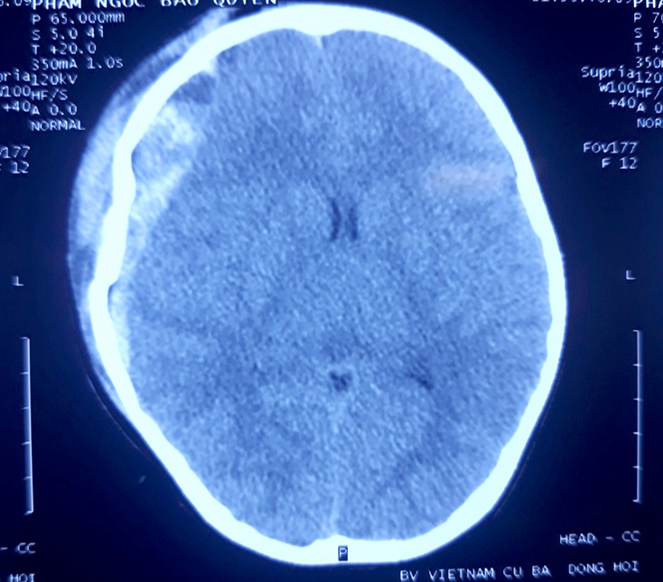 Hình ảnh chấn thương sọ não của cháu bé trên film CT.scan.