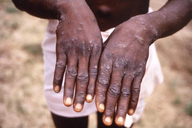  Bàn tay của một bệnh nhân nhiễm bệnh đậu mùa khỉ năm 1997. (Nguồn: straitstimes.com)