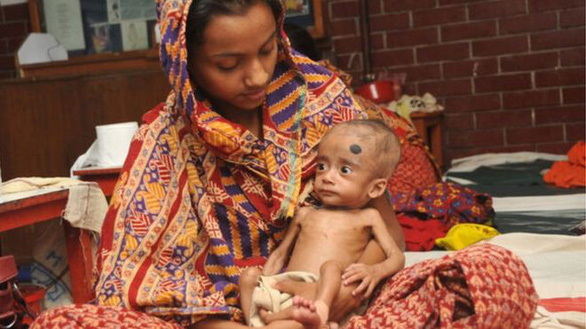 Hiện nay có đến 150 triệu trẻ dưới 5 tuổi bị suy dinh dưỡng - Ảnh: Trung tâm Nghiên cứu Quốc tế bệnh Tiêu chảy