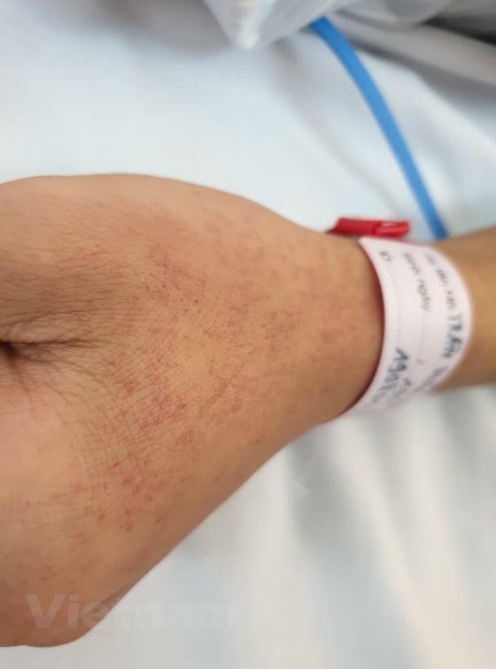 Bệnh nhân mắc bệnh sốt xuất huyết với những nốt phát ban nổi trên da. (Ảnh: T.G/Vietnam+)