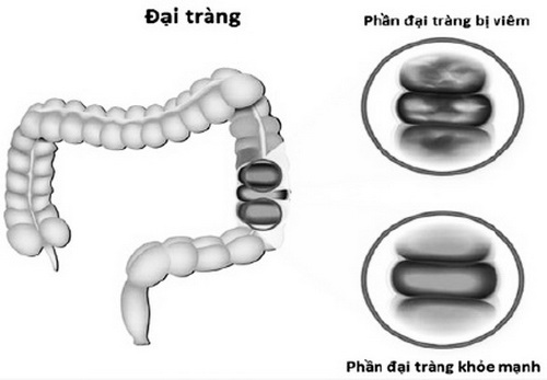 Bệnh viêm đại tràng mạn tính rất khó điều trị dứt điểm và hay tái phát.