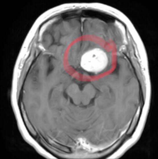 Khối u màng não kích thước lớn trong vùng sàn sọ bệnh nhân.