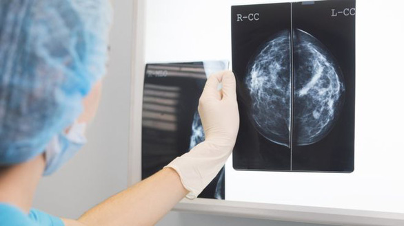 AI có thể dự đoán ung thư vú qua nhũ ảnh chính xác hơn bác sĩ chuyên khoa X-quang - Ảnh: GETTY IMAGES
