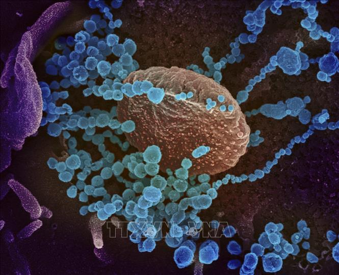 Hình ảnh quét qua kính hiển vi điện tử cho thấy virus SARS-CoV-2 (vật thể tròn màu xanh) nổi lên trên bề mặt tế bào bệnh nhân nhiễm COVID-19. Ảnh: AFP/TTXVN