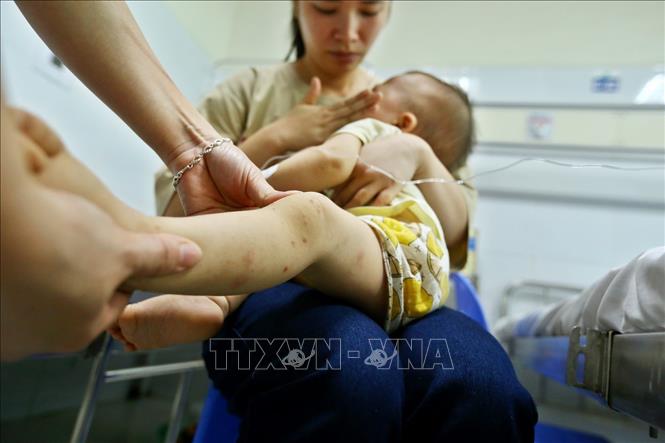 Dấu hiệu của bệnh tay chân miệng như sốt nhẹ hoặc sốt cao, trường hợp sốt cao không thể hạ là dấu hiệu cảnh báo bệnh nặng. Ảnh: Minh Quyết/TTXVN