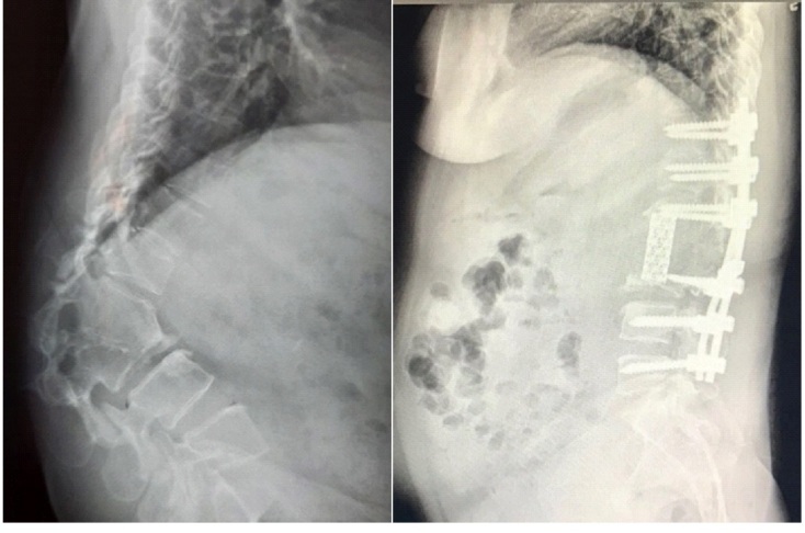 Hình ảnh cột sống bệnh nhân trước và sau khi phẫu thuật.
