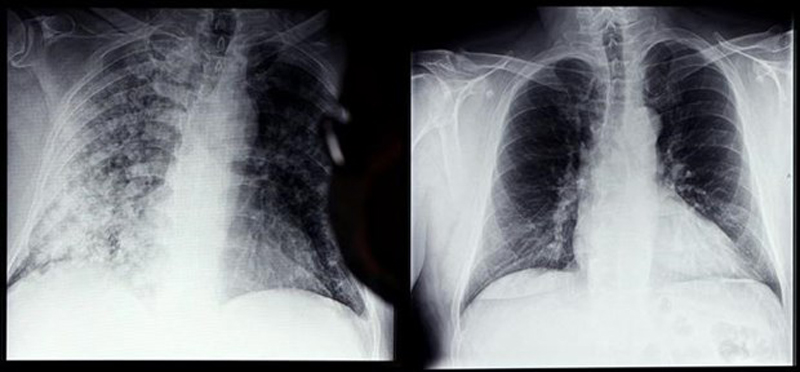 Phim chụp Xquang phổi của bệnh nhân COVID-19 (trái) và phổi của người bình thường tại bệnh viện ở Magdeburg, miền đông nước Đức, ngày 28/4/2021. (Ảnh: AFP/ TTXVN)