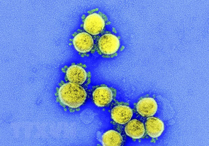 Hình ảnh từ kính hiển vi do Viện Y tế quốc gia Mỹ cung cấp cho thấy virus SARS-CoV-2 trong mẫu bệnh phẩm của bệnh nhân mắc COVID-19 ở Mỹ. (Ảnh: AFP/TTXVN)