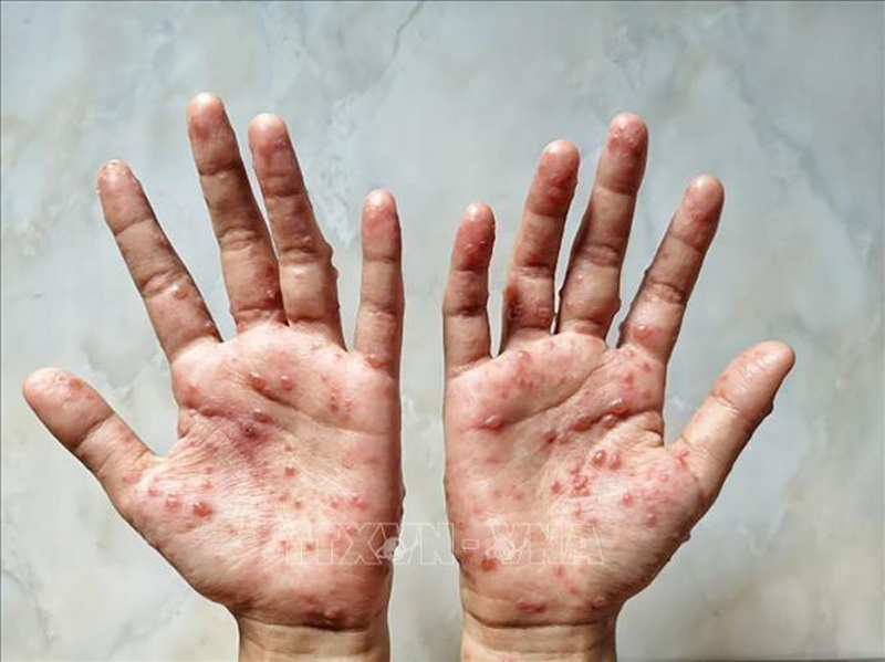 Các ban đỏ nổi trên tay một bệnh nhân mắc bệnh đậu mùa khỉ. Ảnh: Shutterstock/TTXVN