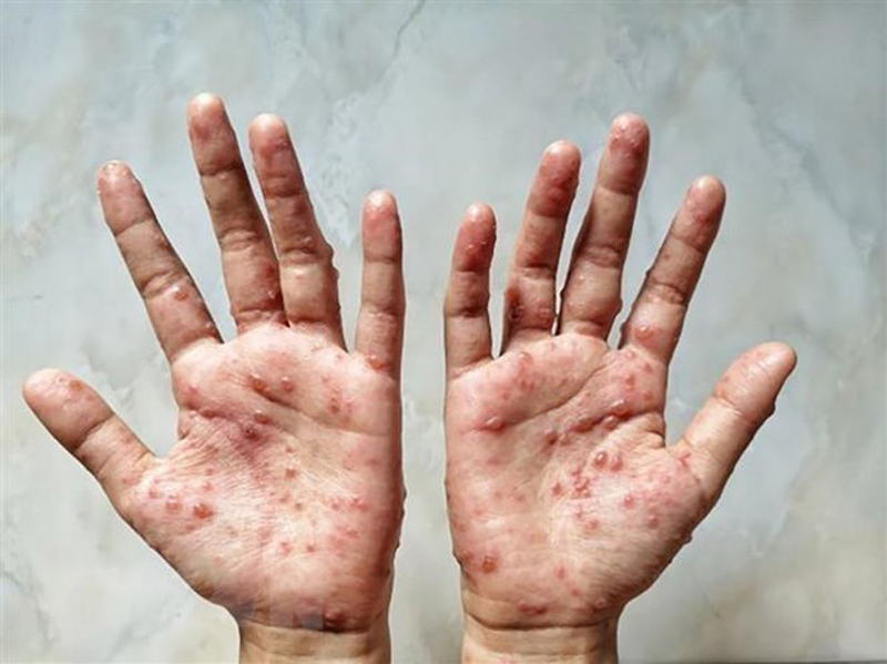 Các ban đỏ nổi trên tay một bệnh nhân mắc bệnh đậu mùa khỉ. (Ảnh: Shutterstock/TTXVN)