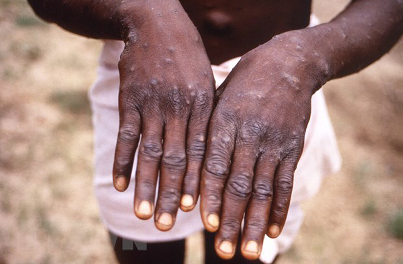 Một trường hợp mắc bệnh đậu mùa khỉ. (Ảnh: AFP/Vietnam+)
