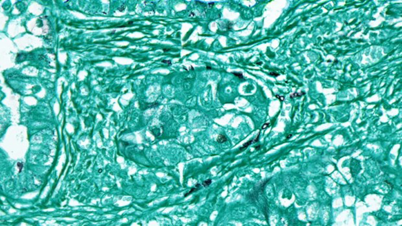 Tế bào nấm (màu đen) nằm trong mẫu mô khối u ung thư phổi (màu xanh). (Nguồn: statnews.com)