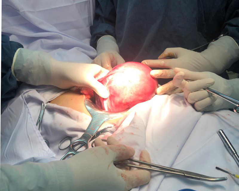 Sau hơn 1 giờ phẫu thuật, khối u nặng 1,2kg đã được cắt bỏ an toàn cho nữ bệnh nhân.