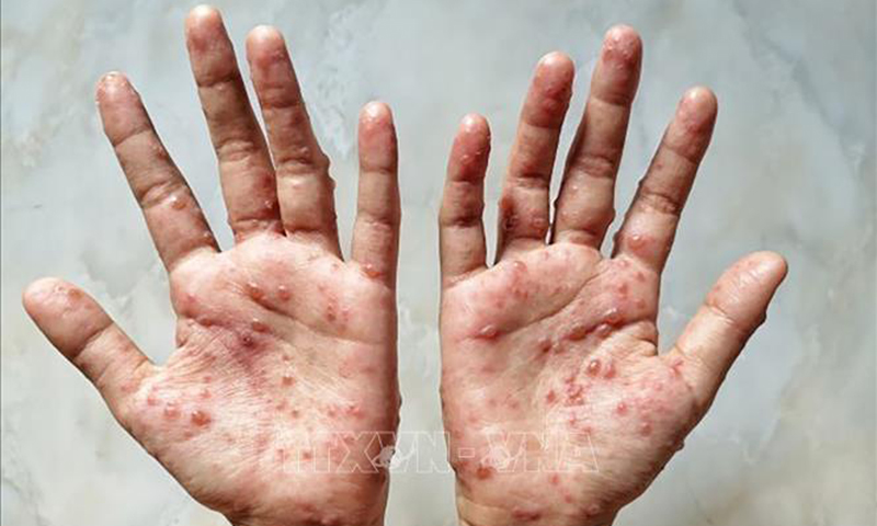  Các ban đỏ nổi trên tay một bệnh nhân mắc đậu mùa khỉ. Ảnh: Shutterstock/TTXVN