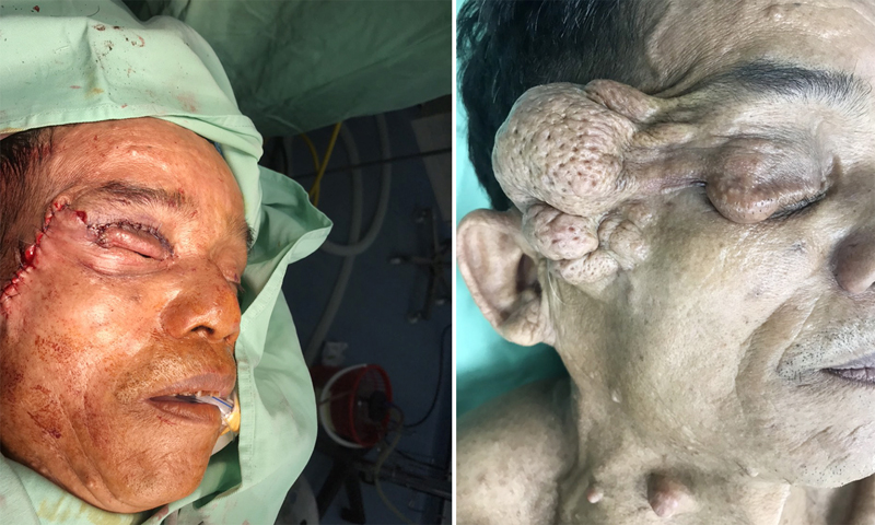 Bệnh nhân Đoàn Việt trước và sau phẫu thuật tại Bệnh viện Hữu nghị Việt Nam-Cuba Đồng Hới.