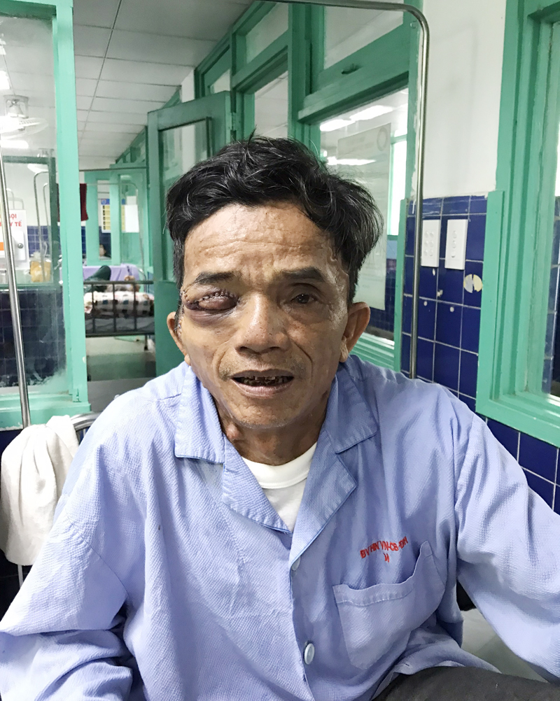 Trưa 17/11/2022, bệnh nhân Đoàn Việt đã tỉnh táo bình thường sau ca phẫu thuật, gửi lời cảm ơn tới đội ngũ y bác sĩ Bệnh viện Hữu nghị Việt Nam-Cuba Đồng Hới và những người đã giúp đỡ mình trở lại khuôn mặt bình thường.