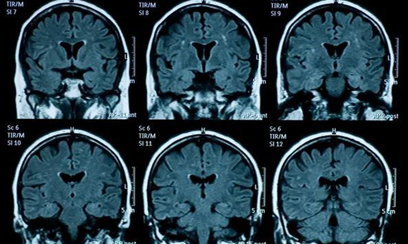 Sức khỏe tâm thần giảm sút đi đôi với những thay đổi về cấu tạo vật lý của não bộ ở thiếu niên. (Nguồn: Getty Images)