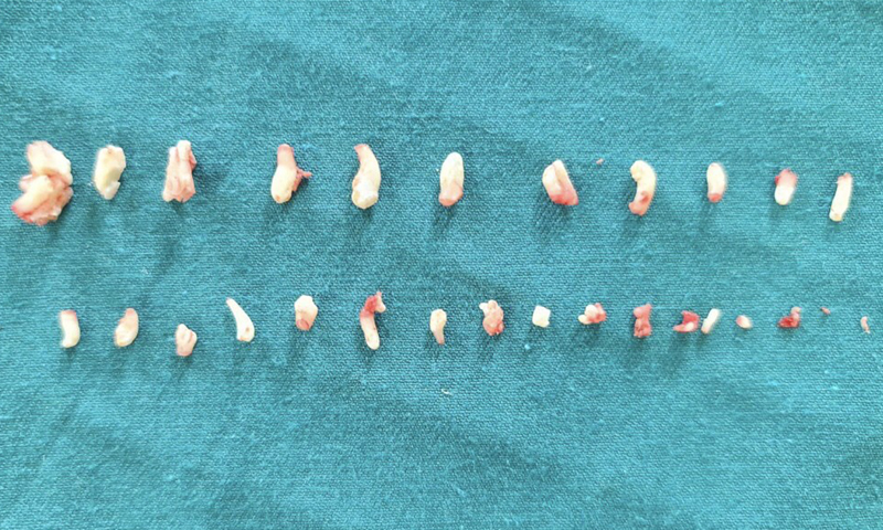 Bệnh nhân N.H.T.M  được phẩu thuật cắt bỏ khối u và gắp ra hơn 28 cái răng lớn, nhỏ.