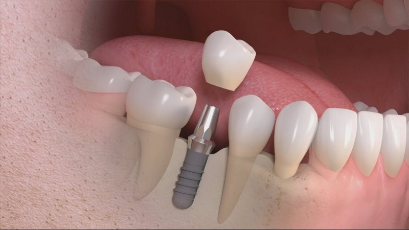 Cấy ghép Implant là phương pháp phục hình răng ưu việt nhất