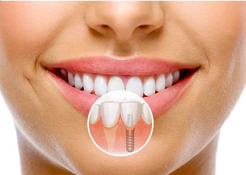 Răng Implant trở thành bộ phận thiết yếu trong cơ thể