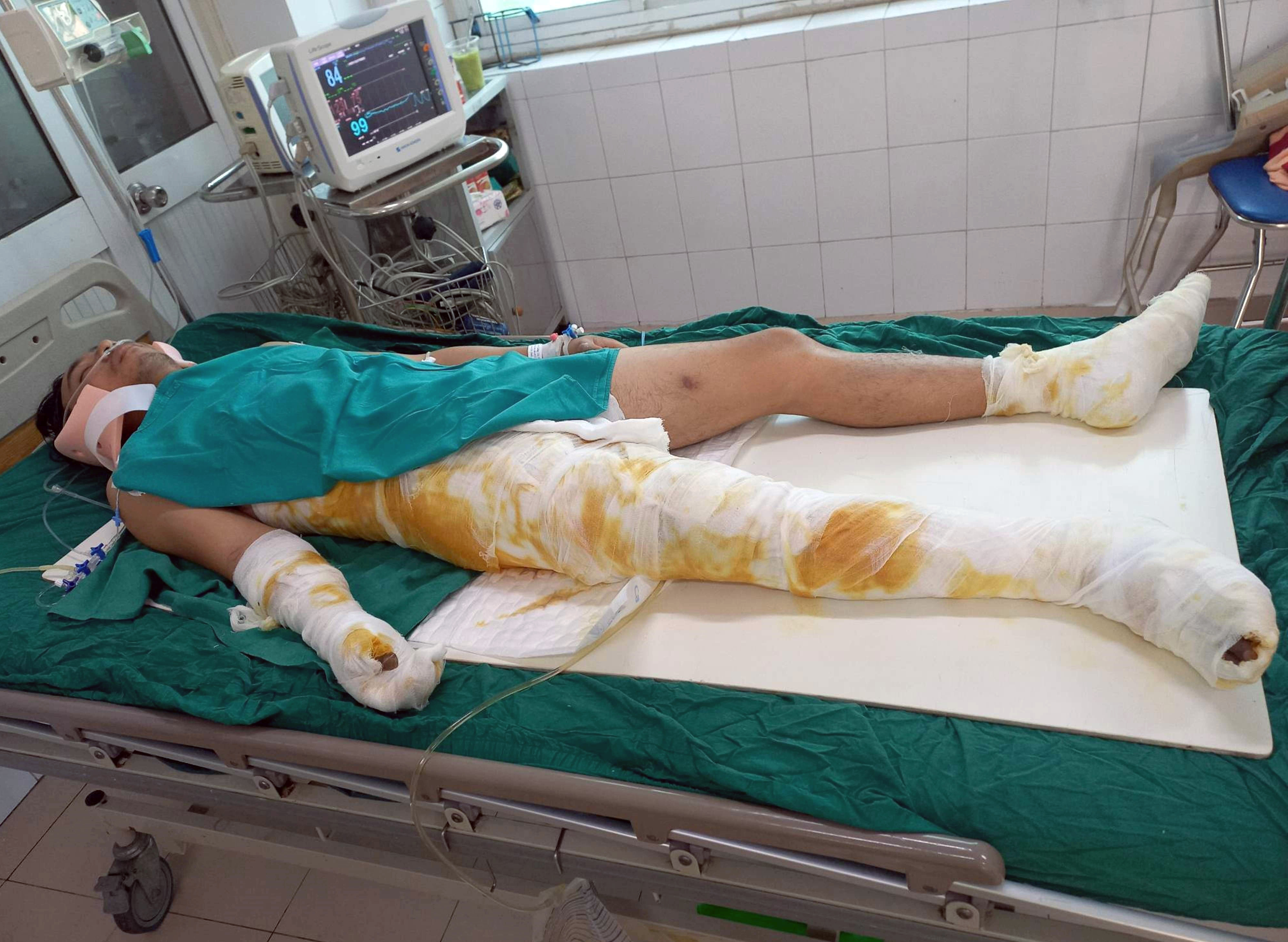Anh Trương Văn Năm đang điều trị tại Bệnh viện Bỏng quốc gia Lê Hữu Trác.