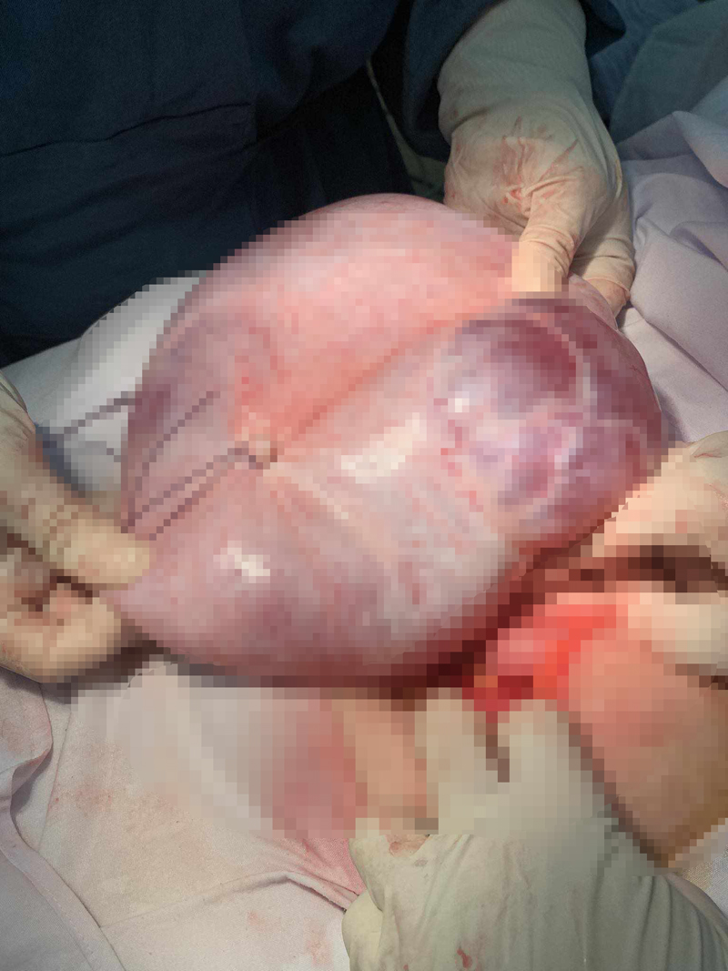Khối u nang buồng trứng nặng gần 5kg được phẫu thuật cắt bỏ.