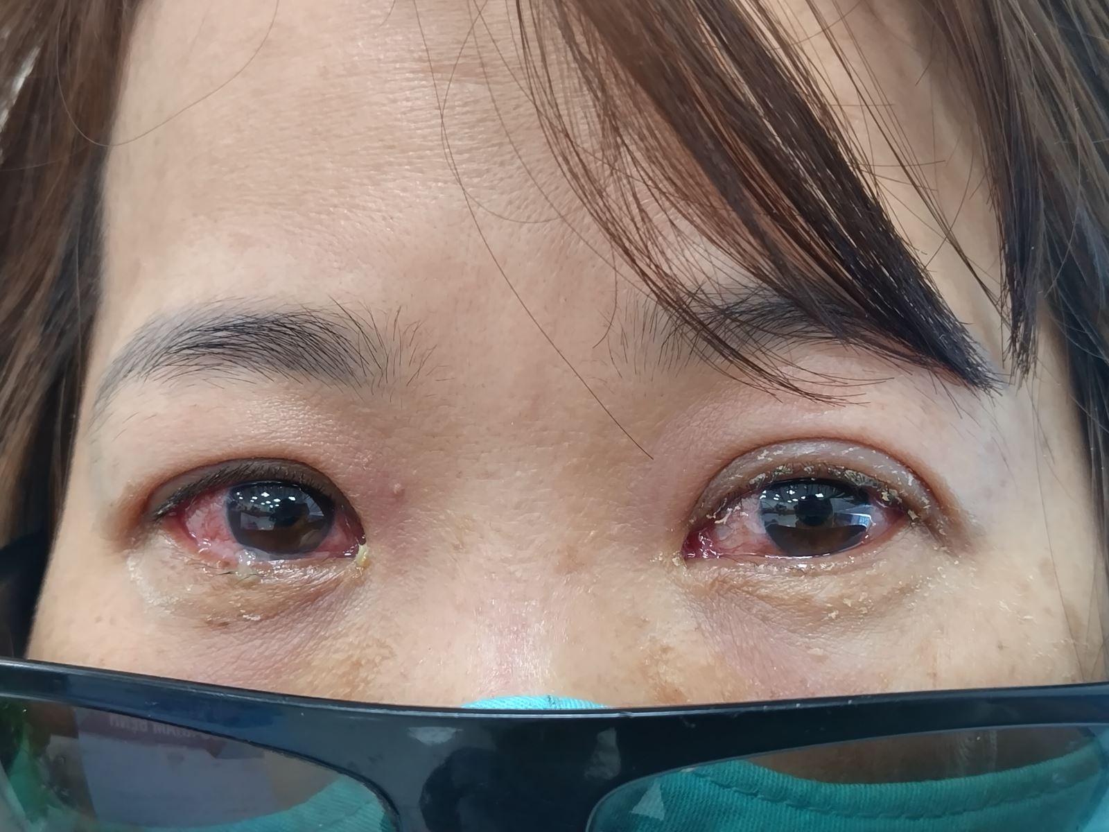 Các triệu chứng của bệnh đau mắt đỏ như mắt đỏ, tiết nhiều ghèn và chảy nước mắt sống. Ảnh: D.T