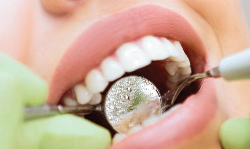 Các chuyên gia khuyến cáo nên định kỳ lấy vôi răng 6-12 tháng/lần