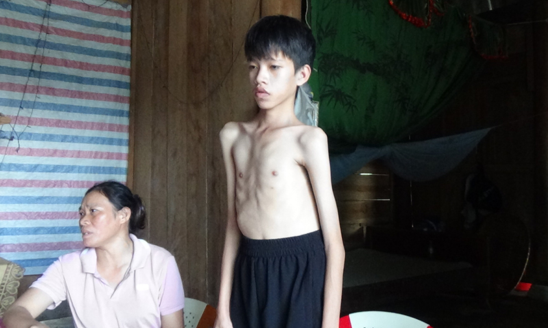 không có chi phí phẫu thuật, cột sống của em Nguyễn Quang Triều ngày càng bị vẹo nặng hơn.