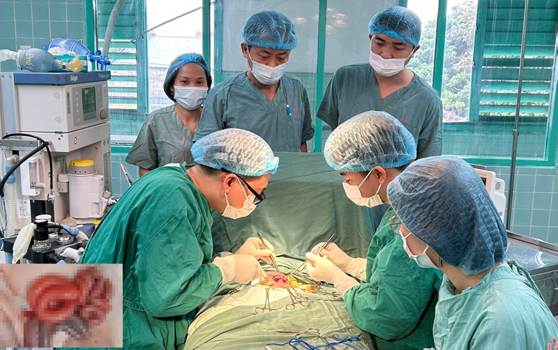 Các y bác sĩ Bệnh viện Hữu nghị Việt Nam-Cuba Đồng Hới tiến hành mổ đưa ruột vào ổ bụng cho trường hợp trẻ sinh non suy hô hấp bị dị tật thoát vị thành bụng (ảnh nhỏ: ruột của bé bị sổ ra ngoài sau khi chào đời).