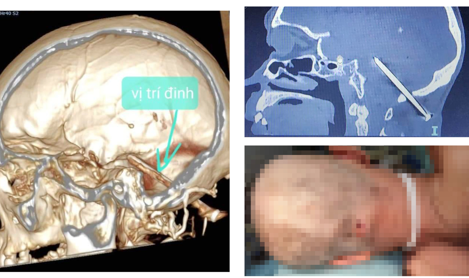 Ảnh chụp CT cho thấy chiếc đinh nằm sâu trong não bệnh nhân.