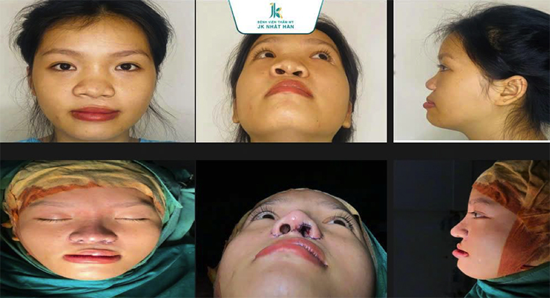 Hình ảnh thực tế của một trường hợp tiêu biểu trước và sau phẫu thuật tạo hình.