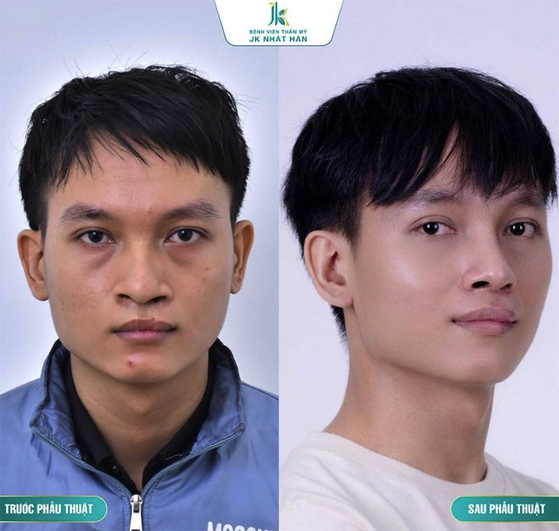 Một trường hợp dị tật mũi được tạo hình thành công.