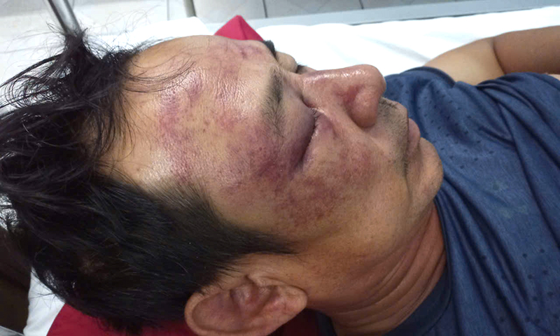 Người đàn ông ở xã Ngư Thủy bị nhóm lạ tấn công phải nhập viện