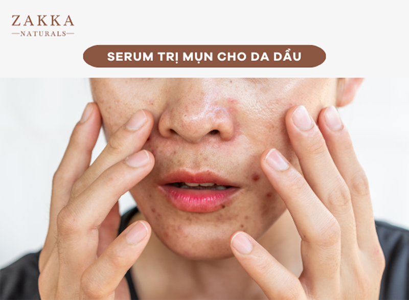 Serum trị mụn cho da dầu