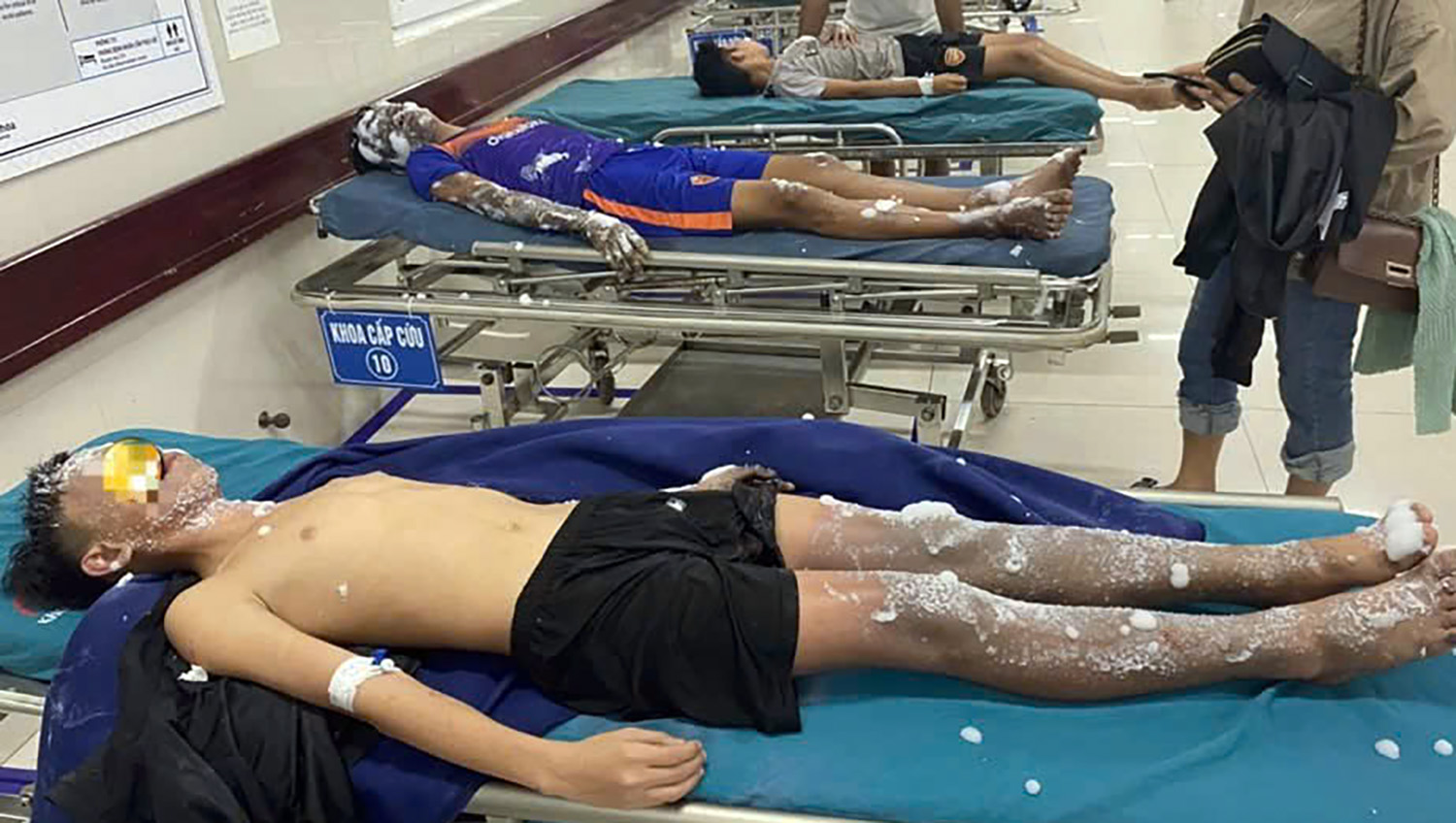 Tiếp nhận 4 bệnh nhân bị bỏng do "chế tạo" pháo