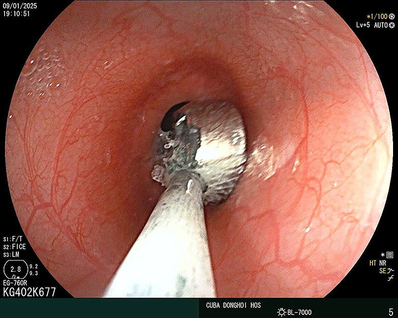 Dị vật được xác định là loại pin hình tròn có đường kính 0,6cm đang có dấu hiệu bị ăn mòn.