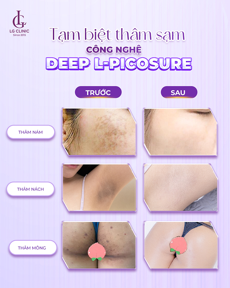 Công nghệ xoá thâm Deep L-Picosure mang lại hiệu quả vượt trội tại nhiều vùng trên cơ thể