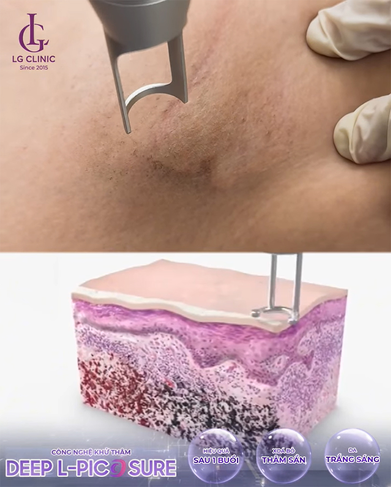 Công nghệ trị thâm Deep L-Picosure tác động sâu vào lớp trung bì và hạ bì của da để phá vỡ các sắc tố melanin
