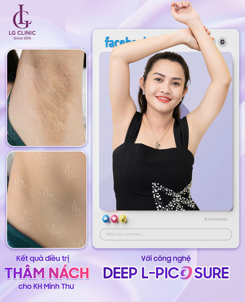 Little Garden Spa ứng dụng công nghệ trị thâm Deep L-Picosure xóa mờ thâm nách chỉ sau 1 liệu trình