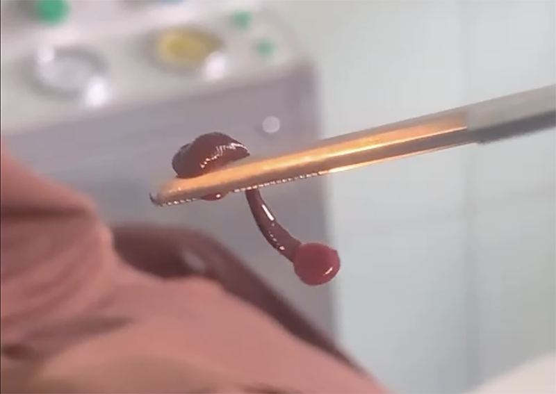 Gắp con vắt ký sinh trong mũi người đàn ông
