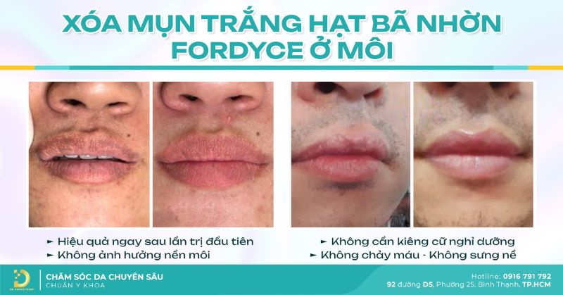 Điều trị mụn trắng hạt bã nhờn fordyce ở môi.