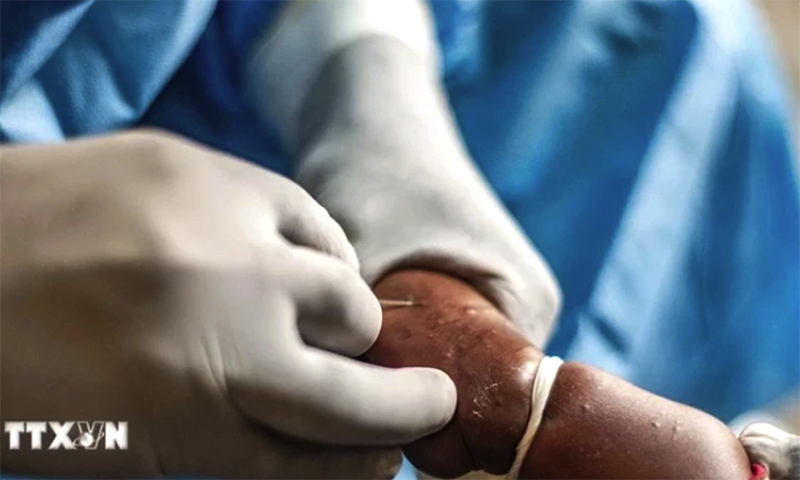 Nhân viên y tế điều trị cho bệnh nhân mắc đậu mùa khỉ tại Goma, Cộng hòa dân chủ Congo, ngày 15/8/2024. (Ảnh: THX/TTXVN)