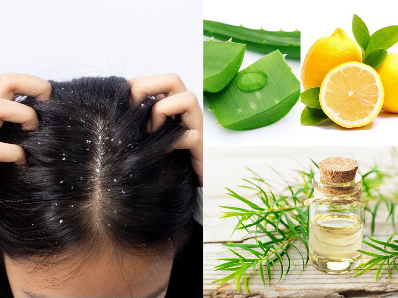 Một số phương pháp tự nhiên giúp chị em trị gàu tại nhà.
